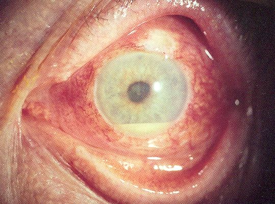 Uveitis mit Eiteransammlung im unteren Teil der Vorderkammer des Auges (Hypopyon) sichtbar als gelblicher Flüssigkeitsspiegel. EyeMD (Rakesh Ahuja, M.D.). CC BY-SA 2.5
