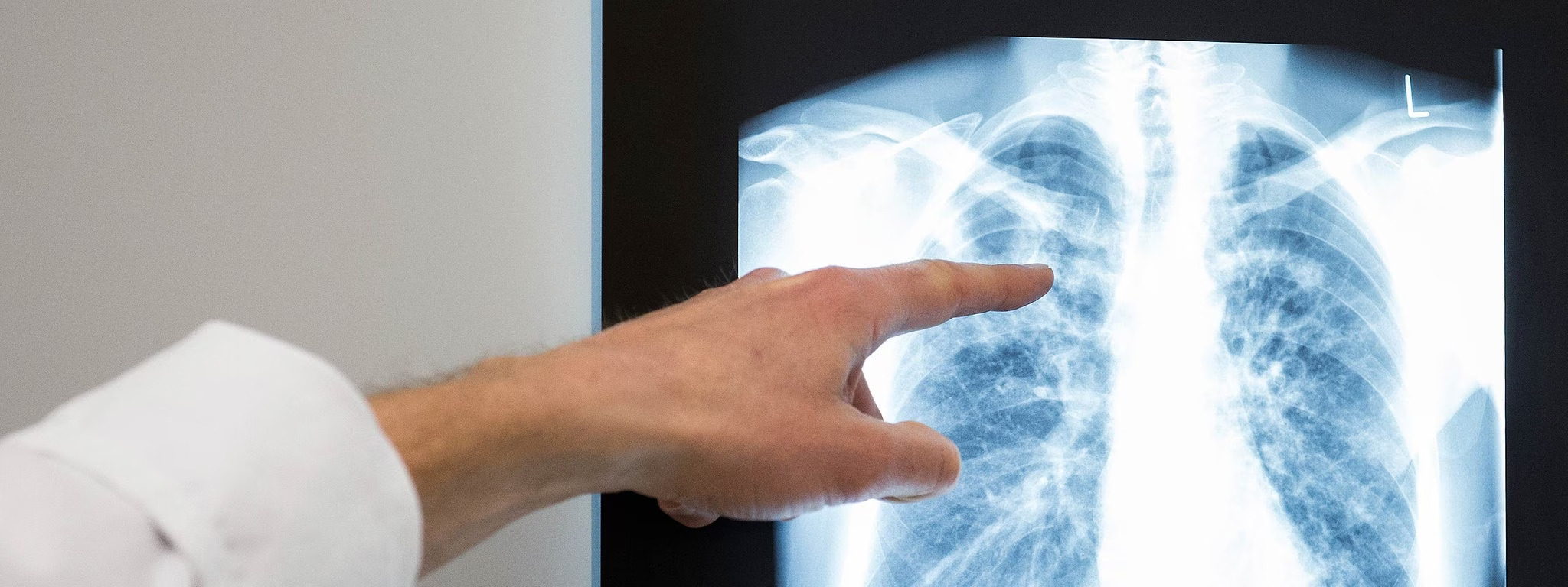 Das Chemnitzer Gesundheitsamt hat weitere Fälle von Tuberkulose gefunden. (Symbolbild)